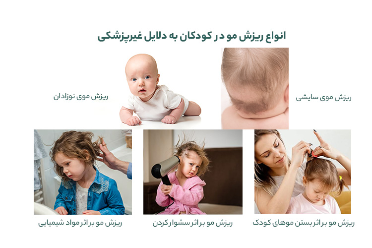 انواع ریزش مو در کودکان به دلایل غیرپزشکی